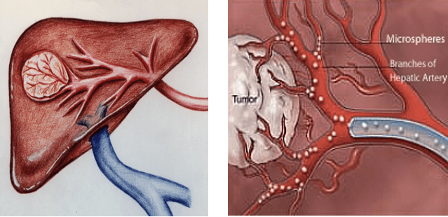 diagram of a tumor